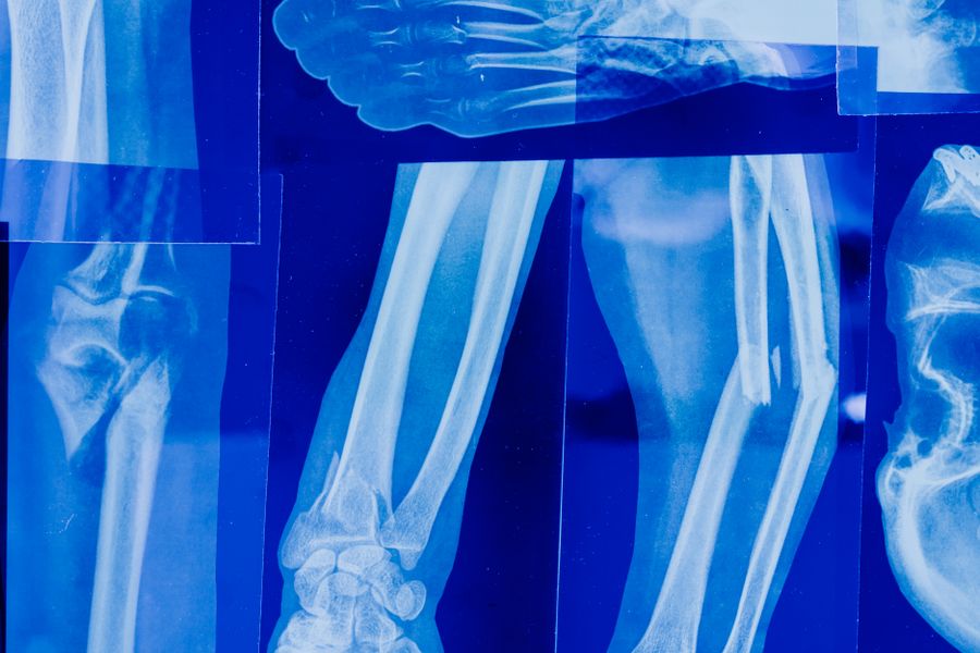 Bone cancer care at Shichim Oncocare
