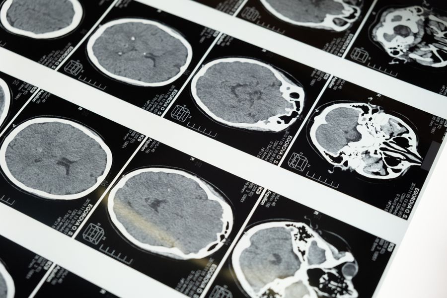 Brain cancer care at Shichim Oncocare