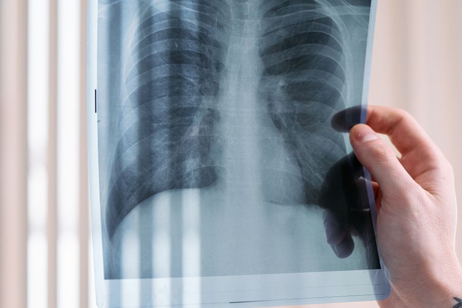 Lung cancer care at Shichim Oncocare